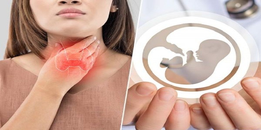 پیامد بارداری در زنان باردار مبتلا به کم کاری تیروئید