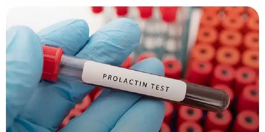 دستور العمل آزمایش پرولاکتین