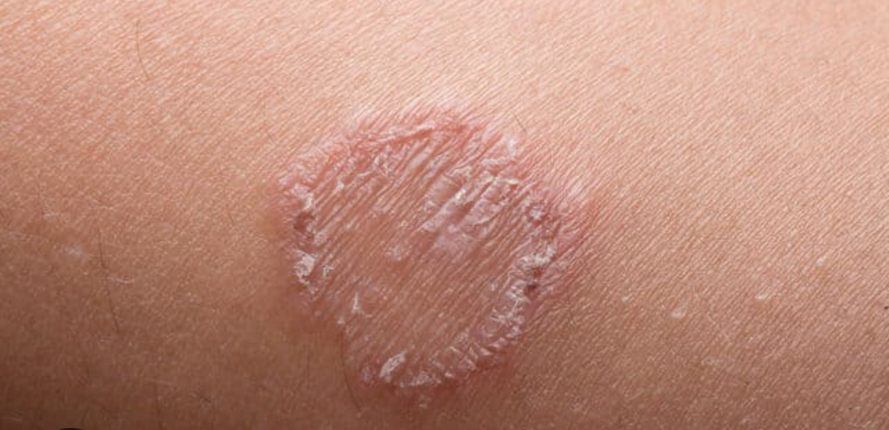 شرایط نمونه گیری آزمایش قارچ پوستی، مو و ناخن